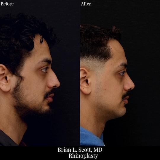 Brian L. Scott, MD rhinoplasty result — Bellevue, WA
