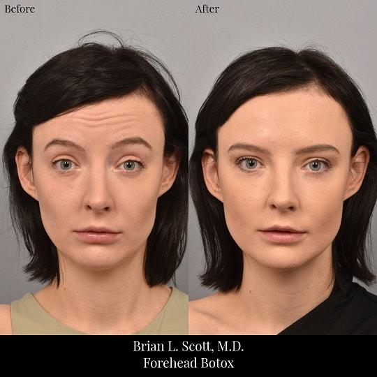 Botox result at Brian L. Scott, MD in Bellevue, WA