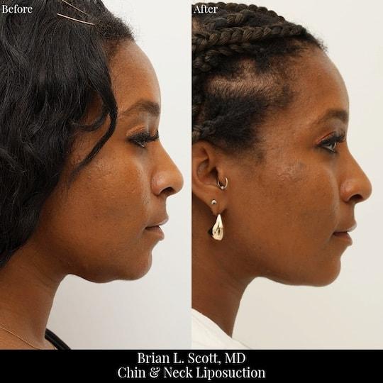 Neck Liposuction result at Brian L. Scott, MD in Bellevue, WA