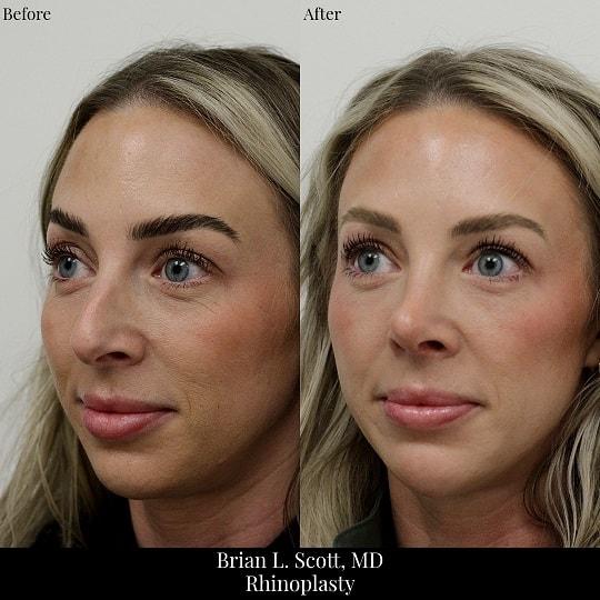 Brian L. Scott, MD rhinoplasty result — Bellevue, WA