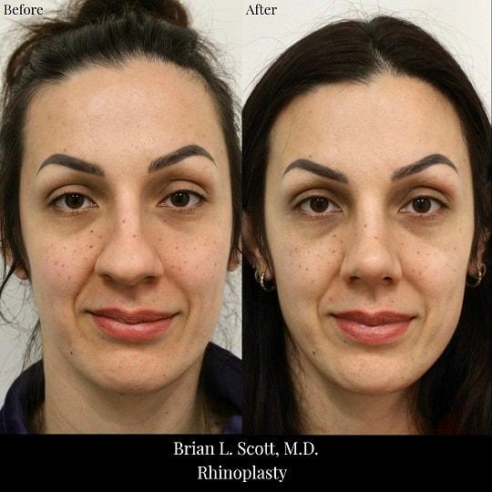 Brian L. Scott, MD rhinoplasty result — Bellevue, WA