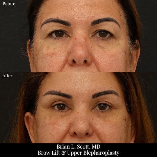 Brow Lift result at Brian L. Scott, MD in Bellevue, WA