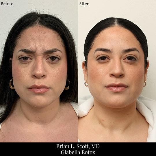Botox result at Brian L. Scott, MD in Bellevue, WA