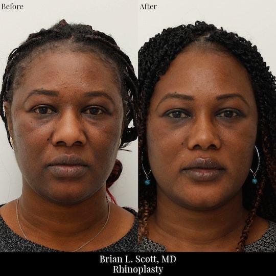 Brian L. Scott, MD rhinoplasty result — Bellevue, WA