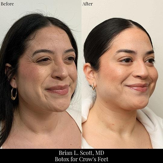 Botox result at Brian L. Scott, MD in Bellevue, WA