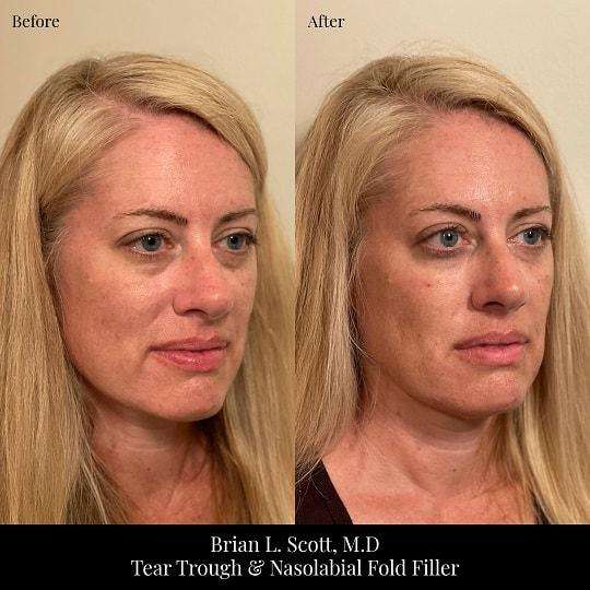 Dermal Fillers result at Brian L. Scott, MD in Bellevue, WA