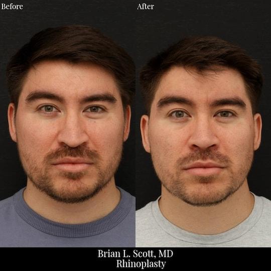 Brian L. Scott, MD rhinoplasty result — Bellevue, WA