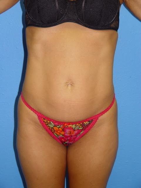 Mommy Makeover before at Joshua A. Halpern, MD in Tampa, FL