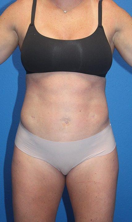Joshua A. Halpern, MD tummy tuck after — Tampa, FL