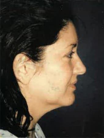 Neck Lift before at Joshua A. Halpern, MD in Tampa, FL