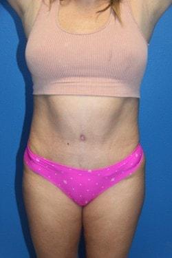Joshua A. Halpern, MD tummy tuck after — Tampa, FL