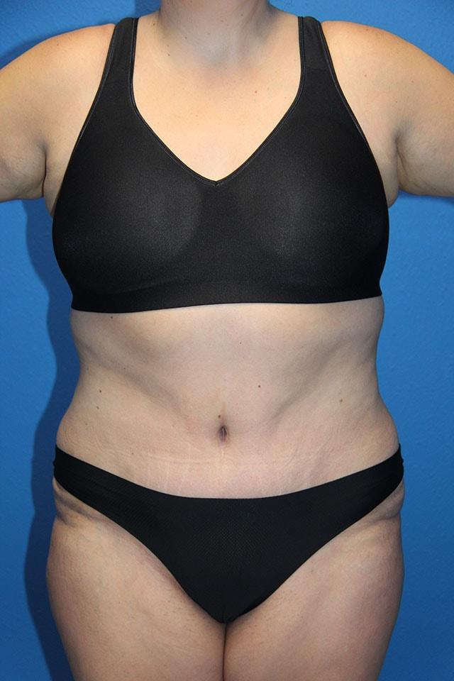 Joshua A. Halpern, MD tummy tuck after — Tampa, FL