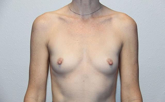 Fat Transfer Breast Augmentation before at Joshua A. Halpern, MD in Tampa, FL
