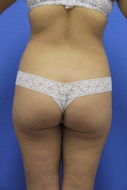 Brazilian Butt Lift before at Joshua A. Halpern, MD in Tampa, FL