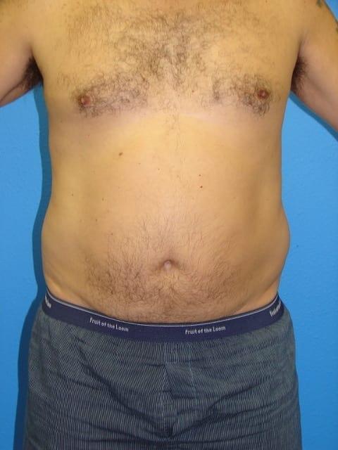 Liposuction before at Joshua A. Halpern, MD in Tampa, FL