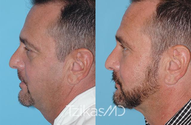 Fat Transfer result at 5th Avenue Plastic Surgery in Delray Beach, FL