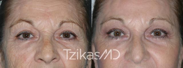 Laser Skin Resurfacing result at 5th Avenue Plastic Surgery in Delray Beach, FL
