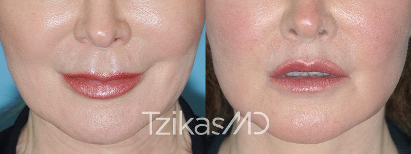 5th Avenue Plastic Surgery lip lift result — Delray Beach, FL