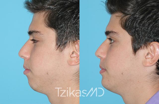Chin Implant result at 5th Avenue Plastic Surgery in Delray Beach, FL