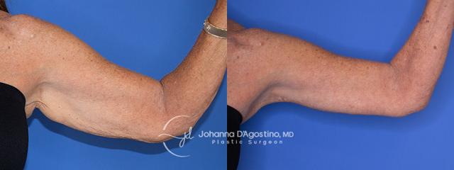 Arm Lift result at 5th Avenue Plastic Surgery in Delray Beach, FL