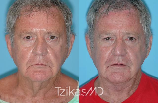 Neck Lift result at 5th Avenue Plastic Surgery in Delray Beach, FL