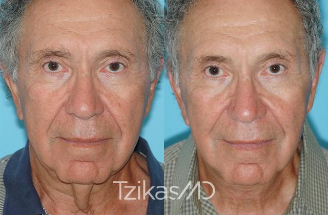 Neck Lift result at 5th Avenue Plastic Surgery in Delray Beach, FL