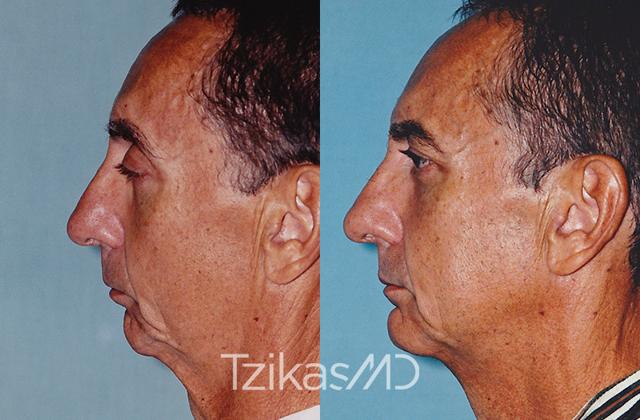 Chin Implant result at 5th Avenue Plastic Surgery in Delray Beach, FL