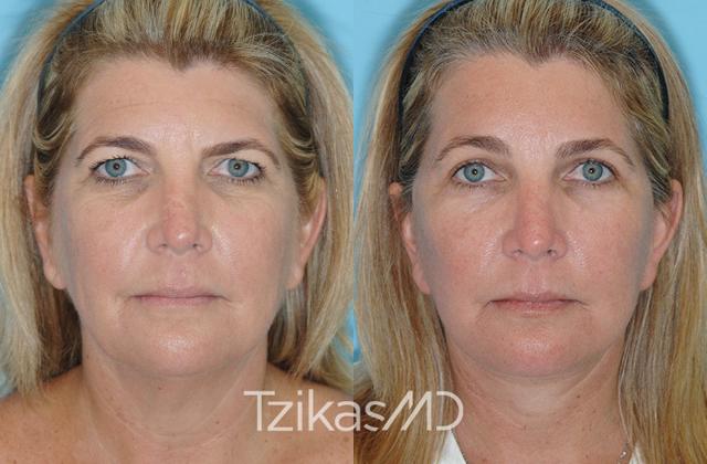 Brow Lift result at 5th Avenue Plastic Surgery in Delray Beach, FL