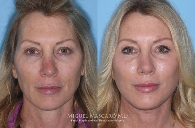 Rhinoplasty result at 5th Avenue Plastic Surgery in Delray Beach, FL