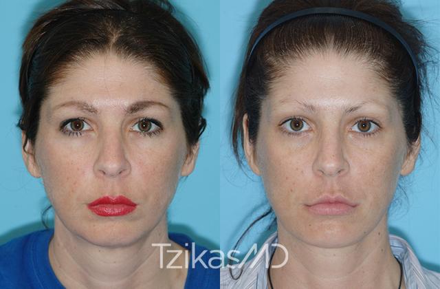 Chin Implant result at 5th Avenue Plastic Surgery in Delray Beach, FL
