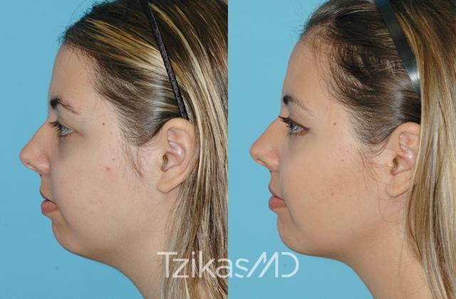 Chin Implant result at 5th Avenue Plastic Surgery in Delray Beach, FL