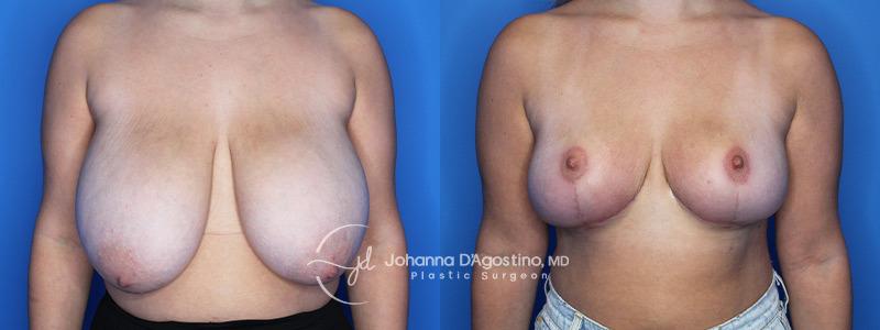 5th Avenue Plastic Surgery breast reduction result — Delray Beach, FL