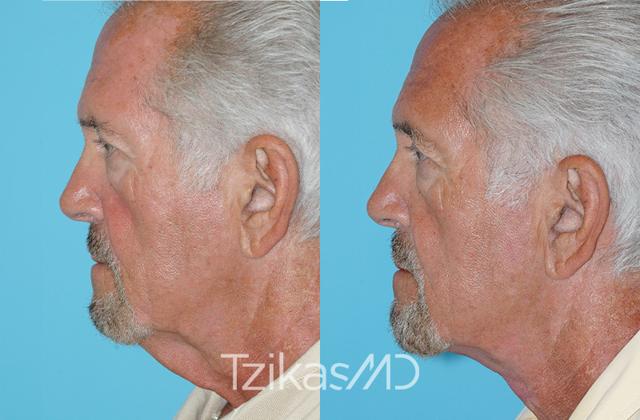 Neck Lift result at 5th Avenue Plastic Surgery in Delray Beach, FL