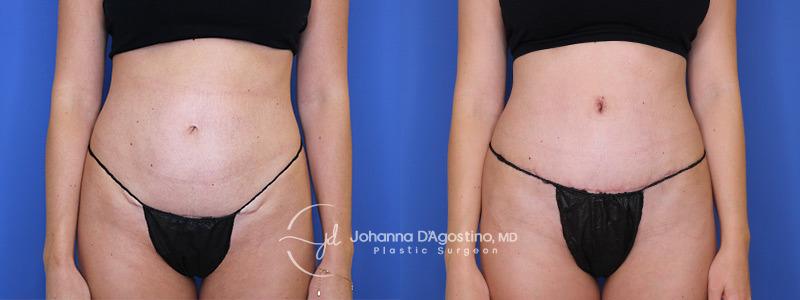 5th Avenue Plastic Surgery tummy tuck result — Delray Beach, FL