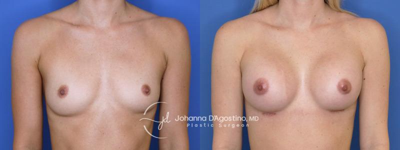 5th Avenue Plastic Surgery breast augmentation result — Delray Beach, FL