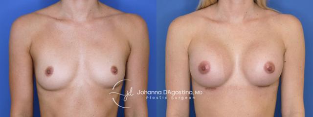 Breast Augmentation result at 5th Avenue Plastic Surgery in Delray Beach, FL