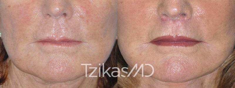 5th Avenue Plastic Surgery lip lift result — Delray Beach, FL