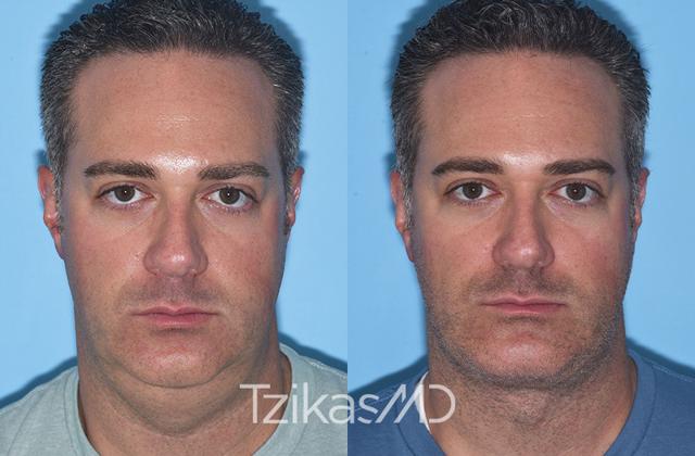 Chin Implant result at 5th Avenue Plastic Surgery in Delray Beach, FL
