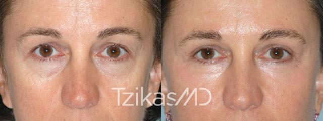 Blepharoplasty result at 5th Avenue Plastic Surgery in Delray Beach, FL
