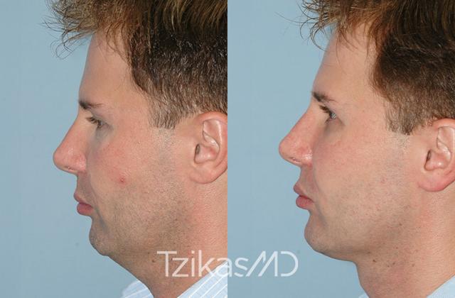 Chin Implant result at 5th Avenue Plastic Surgery in Delray Beach, FL