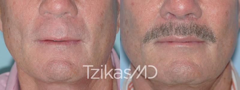 5th Avenue Plastic Surgery lip lift result — Delray Beach, FL