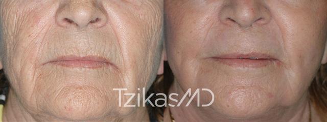 Laser Skin Resurfacing result at 5th Avenue Plastic Surgery in Delray Beach, FL