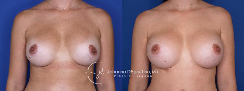 5th Avenue Plastic Surgery breast augmentation revision result — Delray Beach, FL