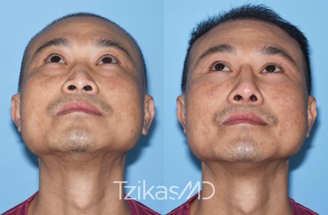 Rhinoplasty result at 5th Avenue Plastic Surgery in Delray Beach, FL