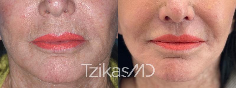 5th Avenue Plastic Surgery lip lift result — Delray Beach, FL