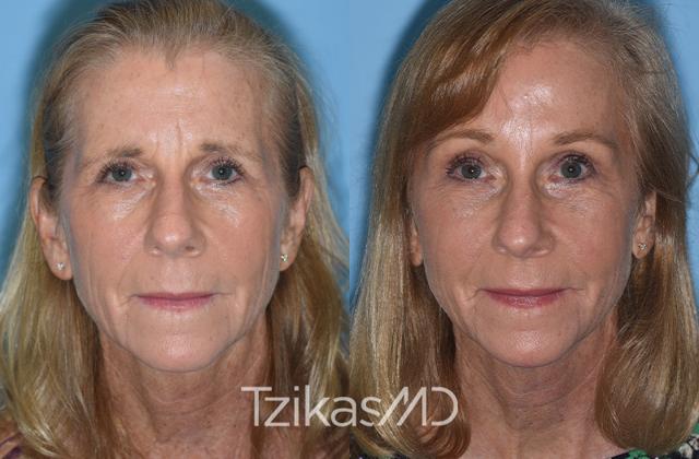 Brow Lift result at 5th Avenue Plastic Surgery in Delray Beach, FL