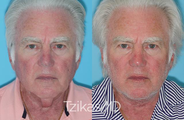 Neck Lift result at 5th Avenue Plastic Surgery in Delray Beach, FL