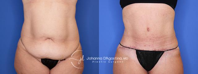 Tummy Tuck result at 5th Avenue Plastic Surgery in Delray Beach, FL