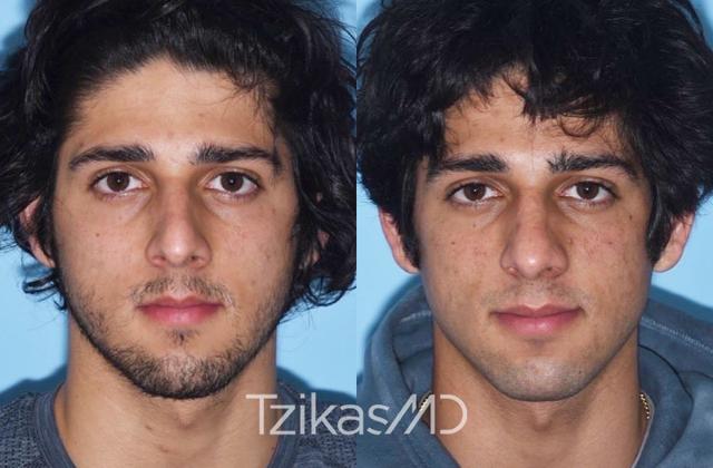 Rhinoplasty result at 5th Avenue Plastic Surgery in Delray Beach, FL