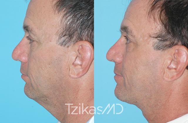 Neck Lift result at 5th Avenue Plastic Surgery in Delray Beach, FL